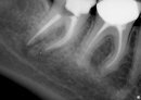 Воспаление корня зуба: симптомы, лечение
