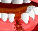 Сколько времени идет кровь после удаления зуба